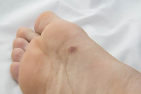 Check Your Feet for Skin Cancer