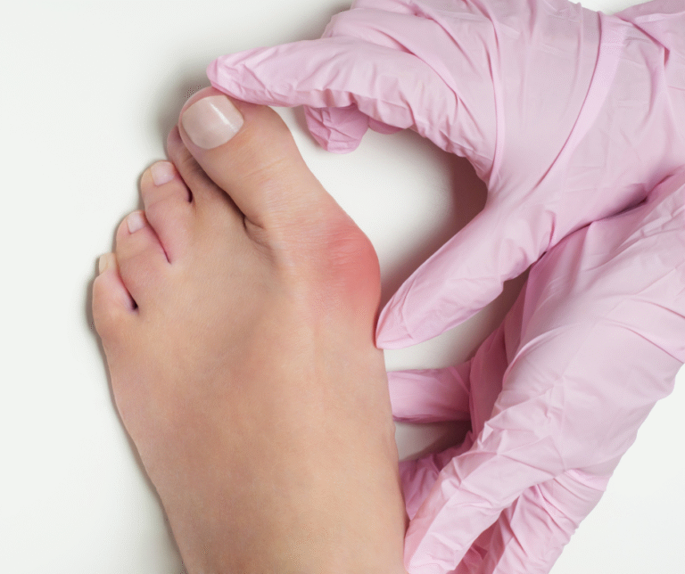 Big News About Bunions