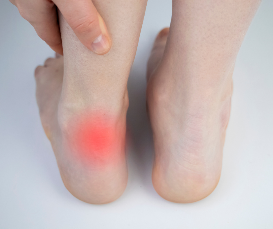 Achilles Tendonitis back of foot pain
