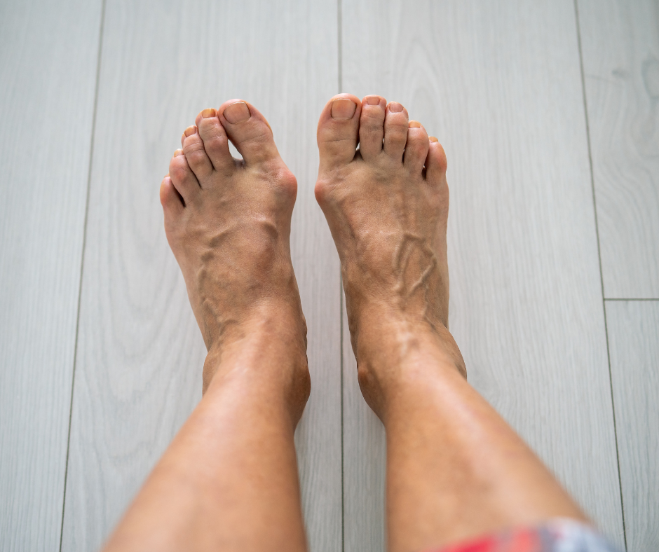 feet with bunions