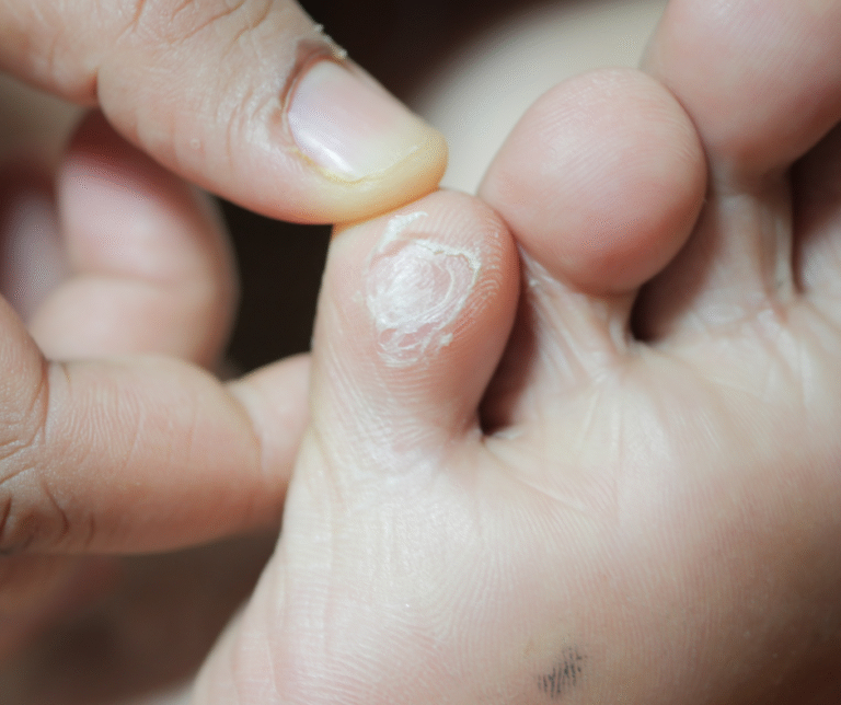 Why You Shouldn’t Try to Remove Calluses and Corns on Your Own 