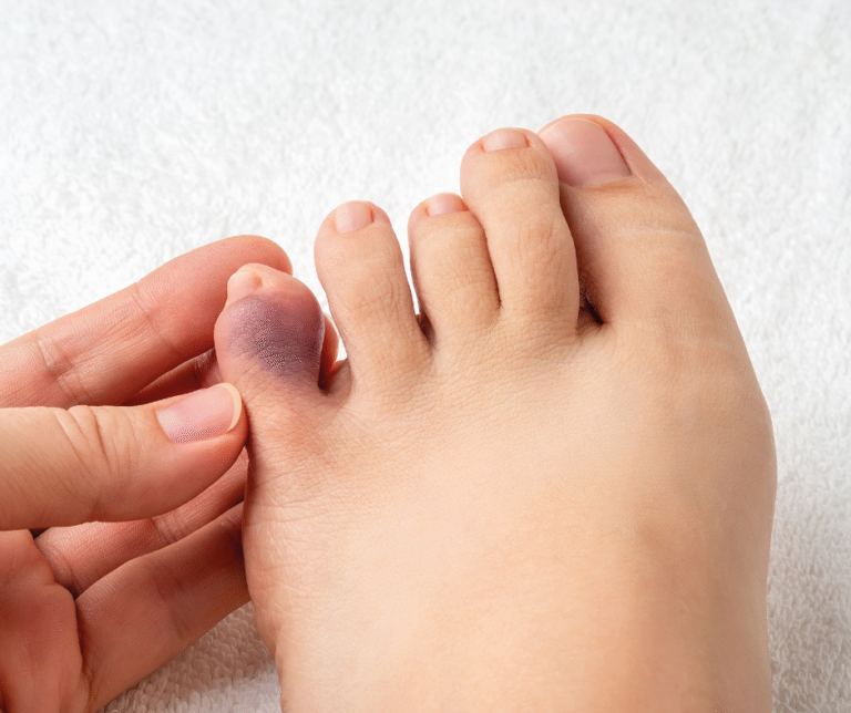 Is My Toe Broken or Just Sprained?