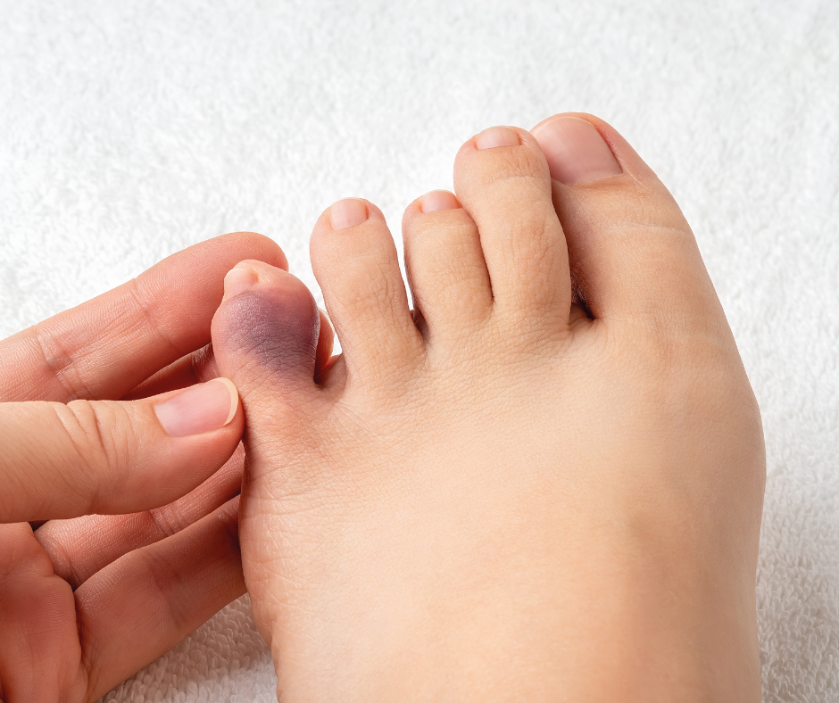 bruised toe