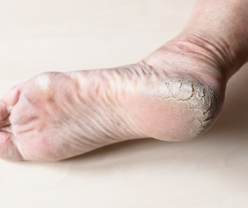 foot with cracked heels