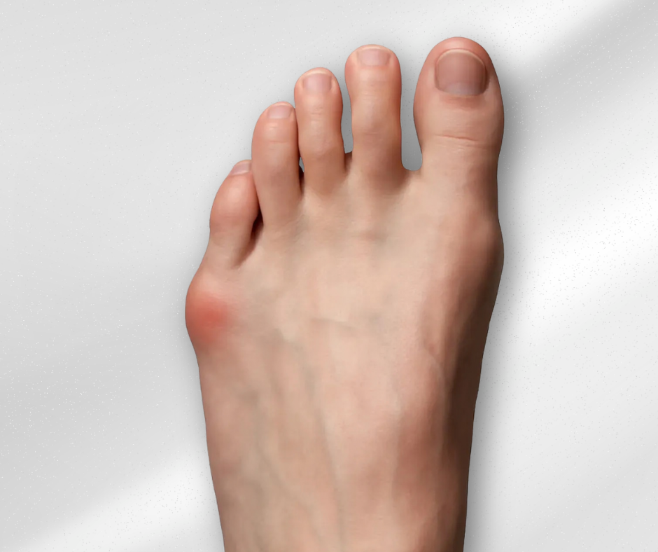 foot with Tailor’s Bunion